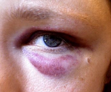 После удара глаз отек, опухоль, красное: лечение