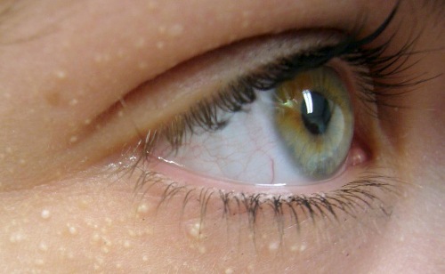 Жировик-милиум вокруг глаз - нередкое явление