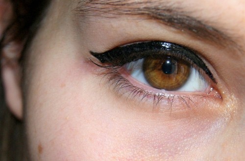 На фото: много мелких жировиков у девушки под глазом сложно скрыть косметикой