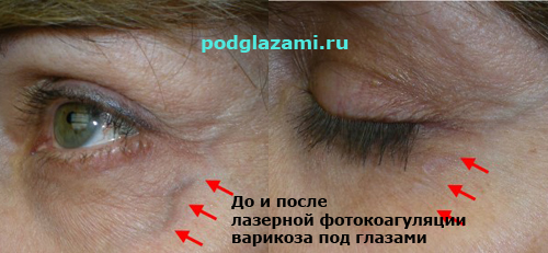 До и после лазерной фотокоагуляции варикозных вен под глазом