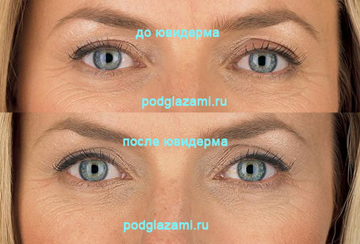 Фото до и после филлеров под глаза (препарат Ювидерм)