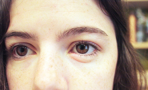 глаз отек из за аллергии