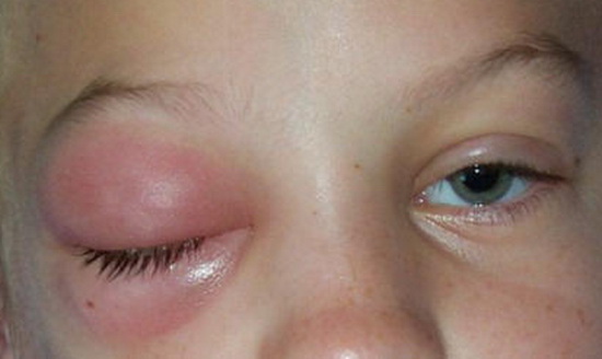 ребенка укусила мошка в глаз