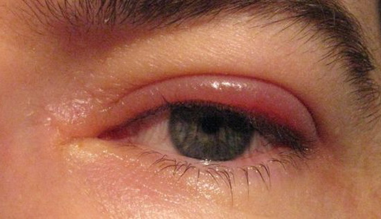 воспаление верхнего века глаза лечение