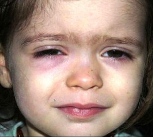 Часто темные пятна под глазами у ребенка возникают из-за усталости и недосыпа
