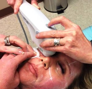 Процедура термажа кожи вокруг глаз