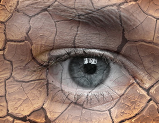 Как вылечить синдром сухого глаза?