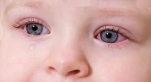 Не оставляйте без внимание состояние глаз у ребенка